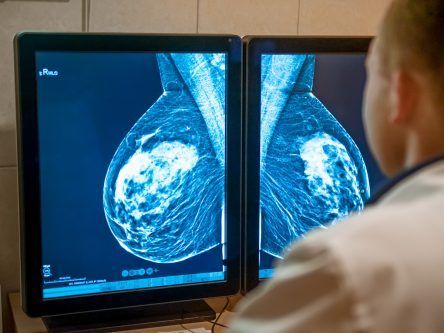 AI can help doctors detect 20pc more cases of breast cancer